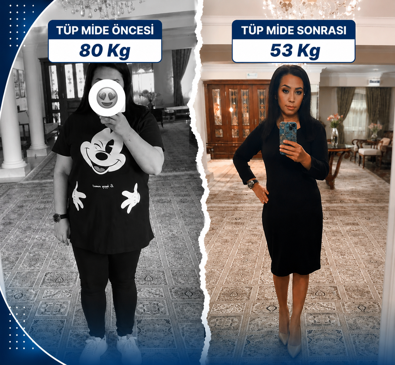 tup-mide-ameliyati-oncesi-sonrasi-012 Ana Sayfa