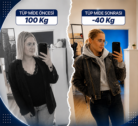 tup-mide-ameliyati-oncesi-sonrasi-016 Ana Sayfa