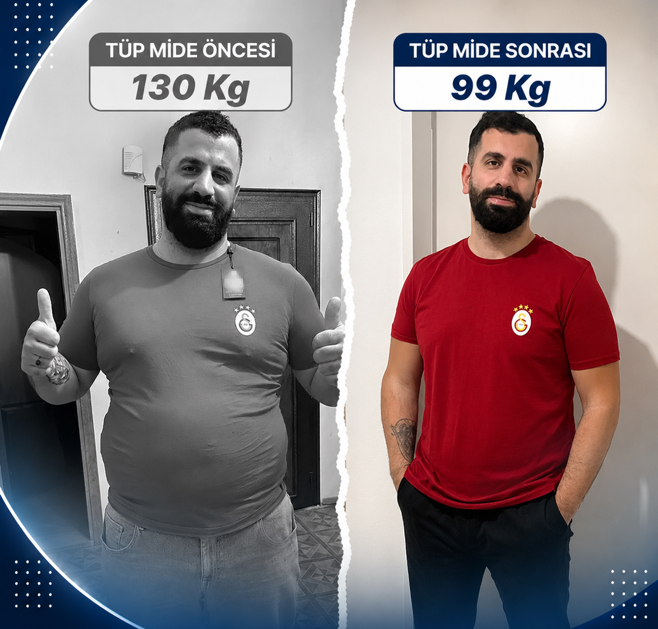 tup-mide-ameliyati-oncesi-sonrasi-017 Ana Sayfa